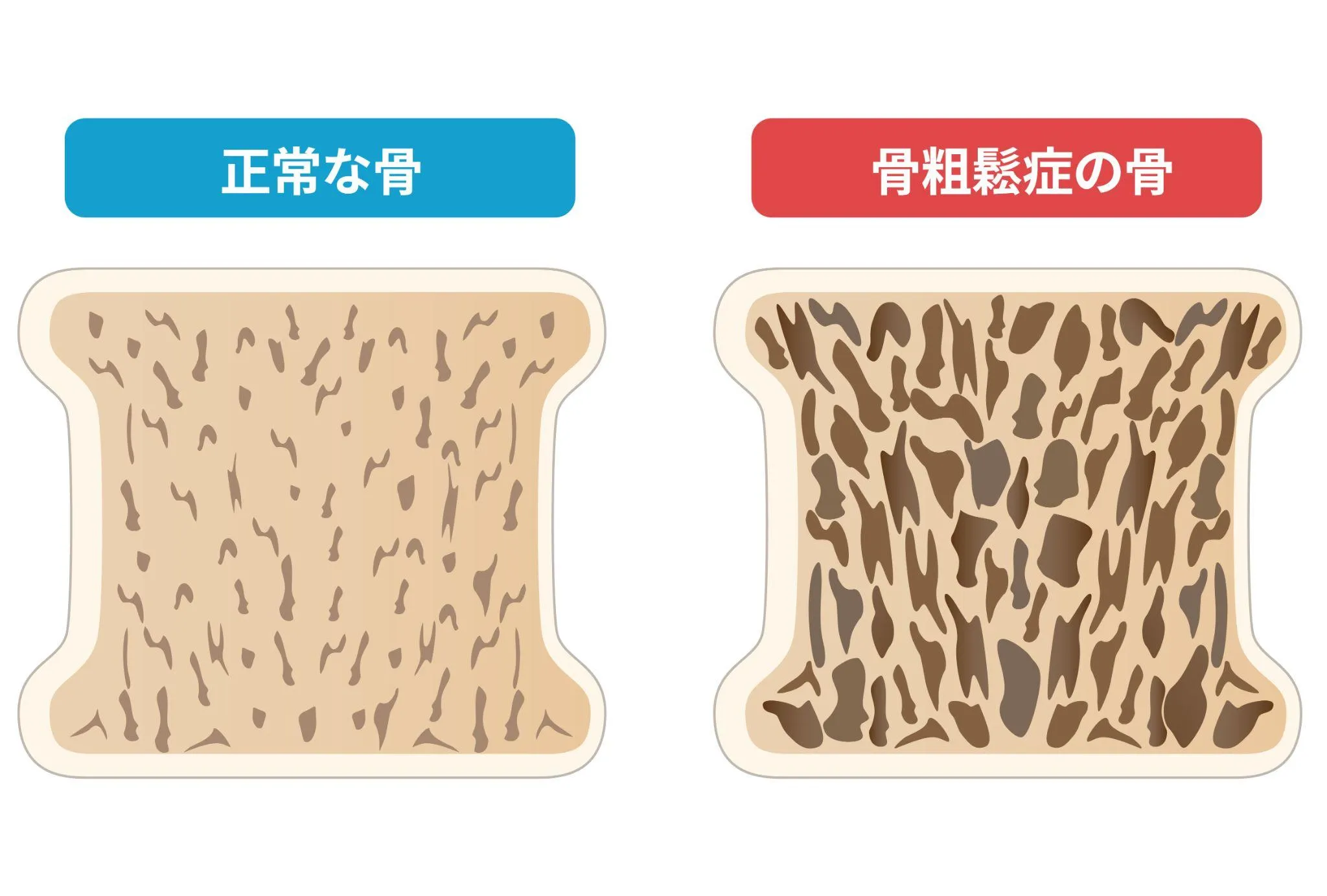 骨粗鬆症とは
