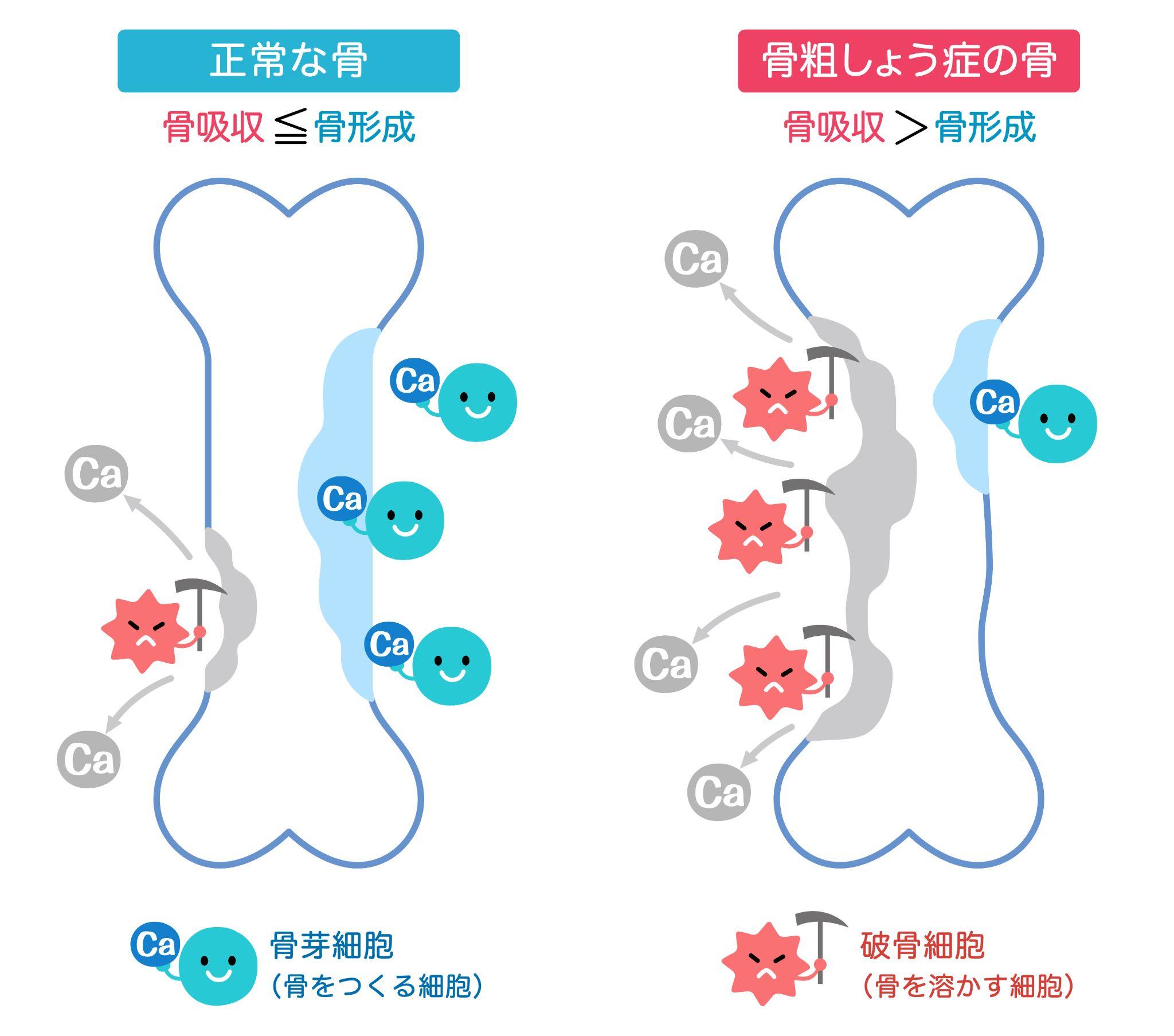 なぜ運動が骨粗鬆症の予防になるのか